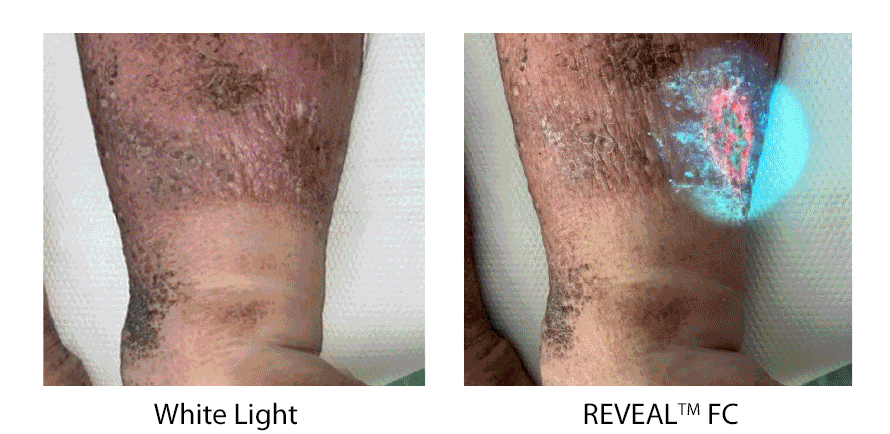 Wound Images with and without REVEAL